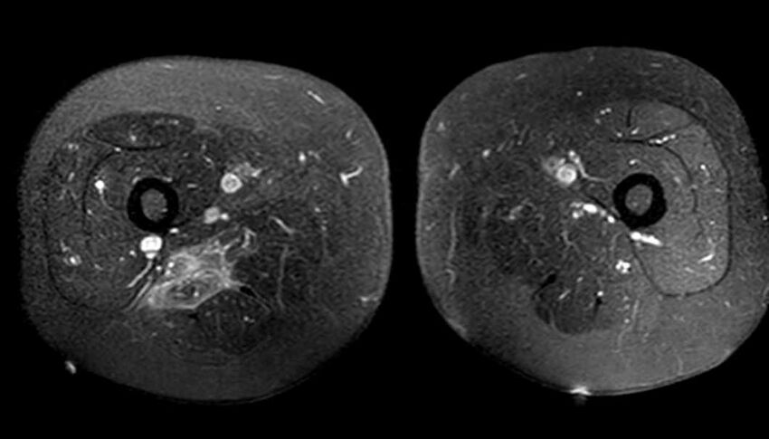 Atypical lipomatous tumor - thigh (Radiopaedia 68975-78734 Axial T1 C+ fat sat 60).jpg