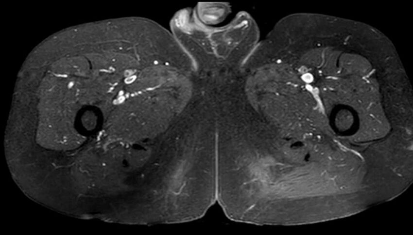 Atypical lipomatous tumor - thigh (Radiopaedia 68975-78734 Axial T1 C+ fat sat 73).jpg