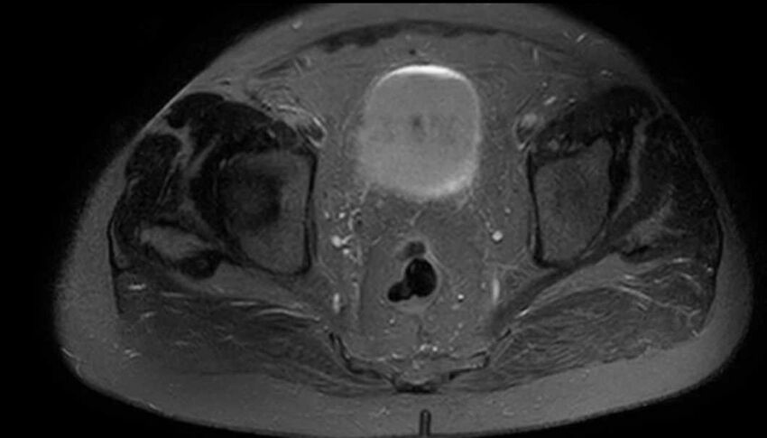Atypical lipomatous tumor - thigh (Radiopaedia 68975-78734 Axial T2 fat sat 98).jpg