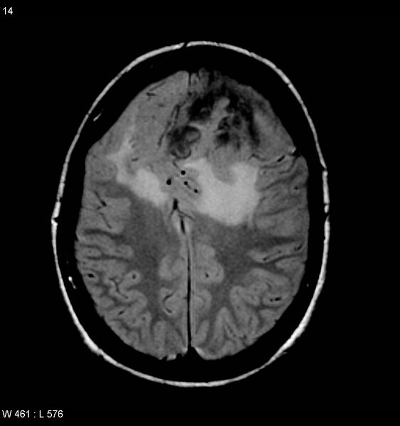 File:Atypical meningioma (WHO grade II) (Radiopaedia 7762-8586 Axial FLAIR 4).jpg