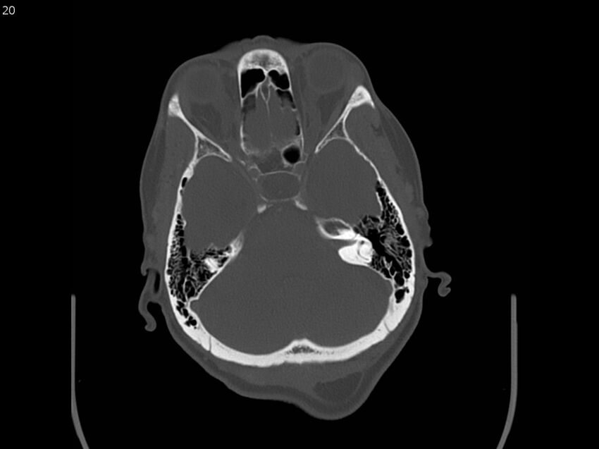Atypical meningioma - intraosseous (Radiopaedia 64915-73867 Axial C+ bone window 20).jpg