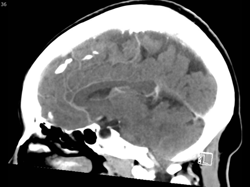 Atypical meningioma - intraosseous (Radiopaedia 64915-73867 F 35).jpg