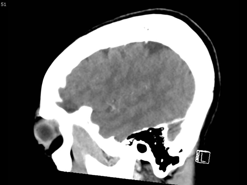 Atypical meningioma - intraosseous (Radiopaedia 64915-73867 F 50).jpg