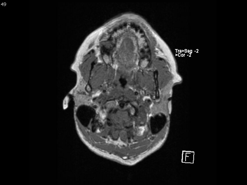 Atypical meningioma - intraosseous (Radiopaedia 64915-74572 Axial T1 49).jpg