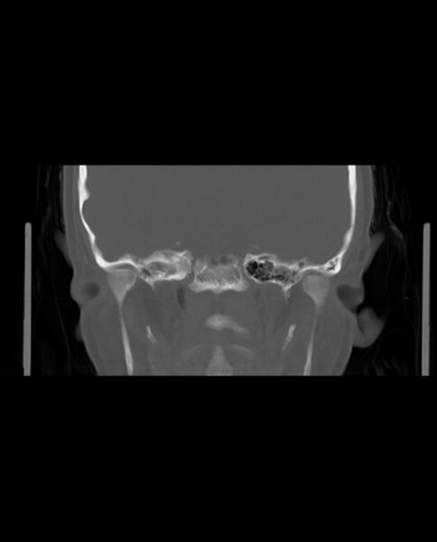 File:Automastoidectomy with labyrinthine fistula (Radiopaedia 84143-99411 Coronal non-contrast 85).jpg