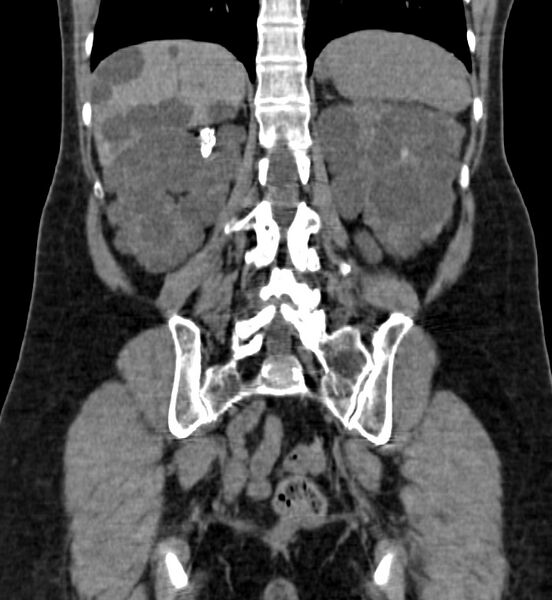 File:Autosomal dominant polycystic kidney disease (Radiopaedia 41918-44922 Coronal non-contrast 37).jpg