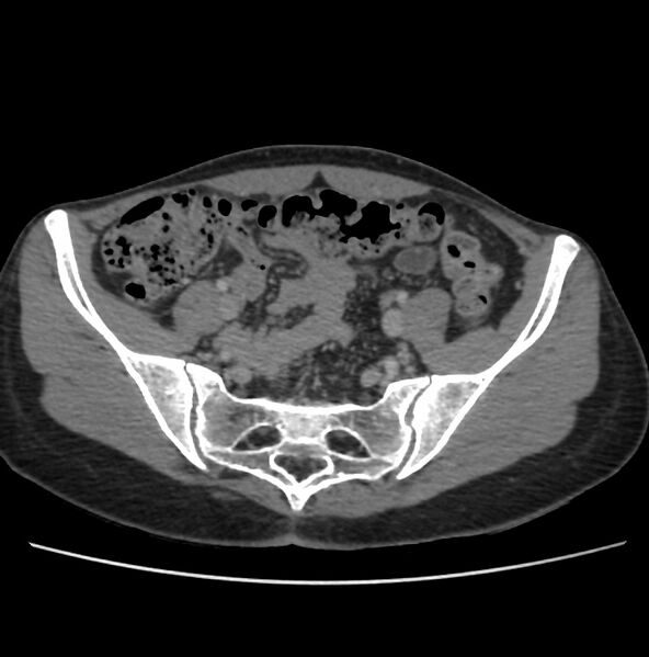 File:Autosomal dominant polycystic kidney disease - early onset (Radiopaedia 40734-43387 A 66).jpg