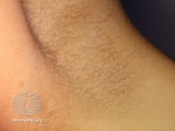 Axillary Fox-Fordyce disease (DermNet NZ hair-nails-sweat-fox-fordyce5).jpg