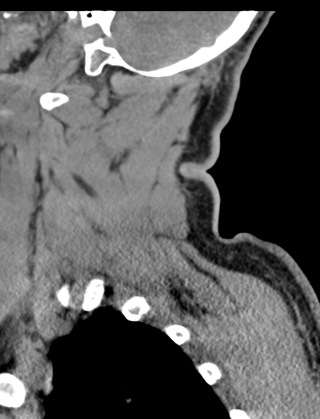 File:Axis peg fracture (type 3) and atlas lateral mass (type 4) fracture (Radiopaedia 37474-39324 D 13).png