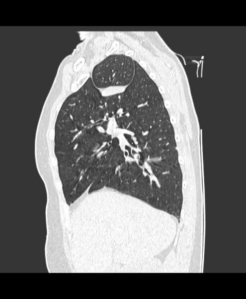File:Azygos fissure and azygos lobe (Radiopaedia 41841-44832 Sagittal lung window 4).jpg
