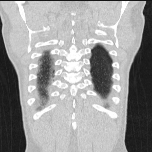 File:Azygos lobe (Radiopaedia 38259-40275 Coronal lung window 70).jpg