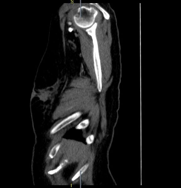 File:Azygos vein aneurysm (Radiopaedia 77824-90130 D 33).JPG