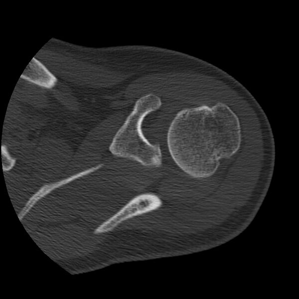 File:Bankart lesion (Radiopaedia 22771-22798 Axial bone window 16).jpg