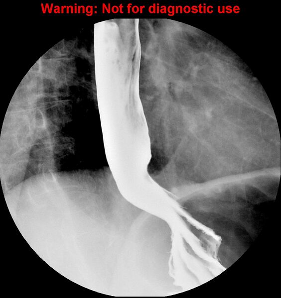 File:Barrett esophagus (Radiopaedia 44421-48075 A 2).jpg