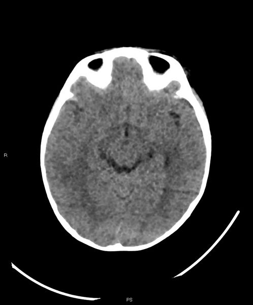 File:Basal ganglia and parenchymal ischemia (Radiopaedia 45818-50083 Axial non-contrast 26).jpg