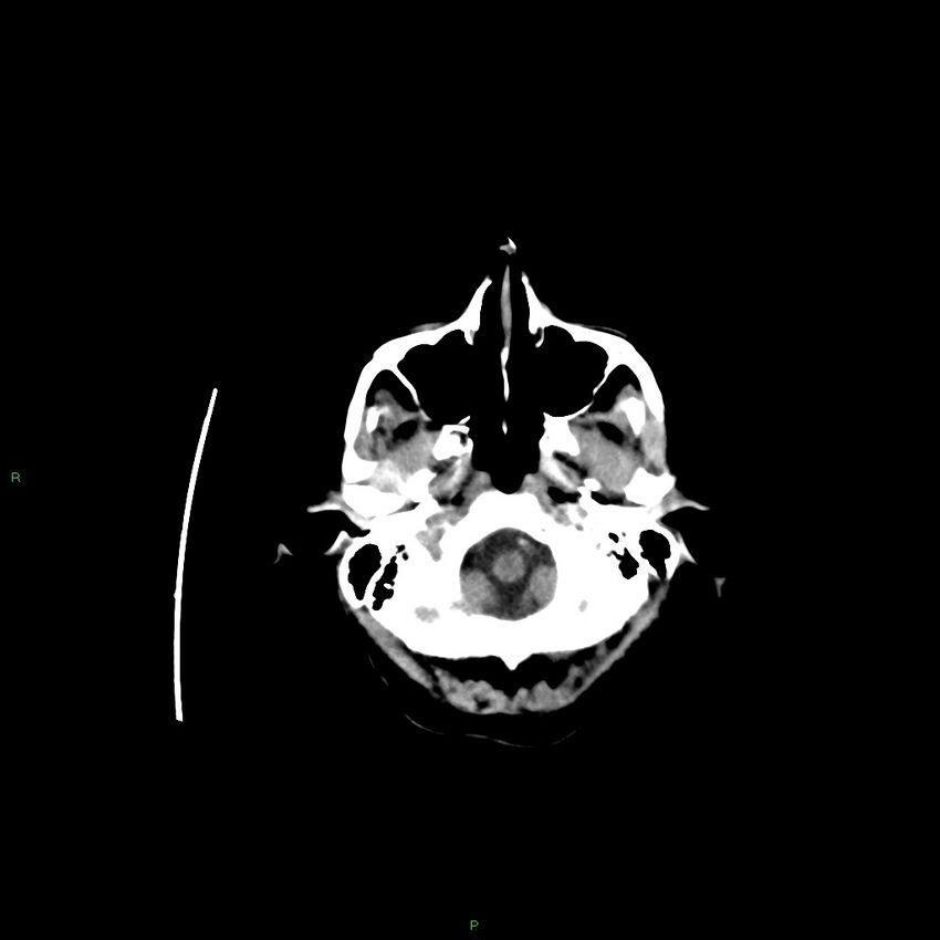 Basal ganglia hemorrhage (Radiopaedia 58350-65473 Axial non-contrast 41).jpg