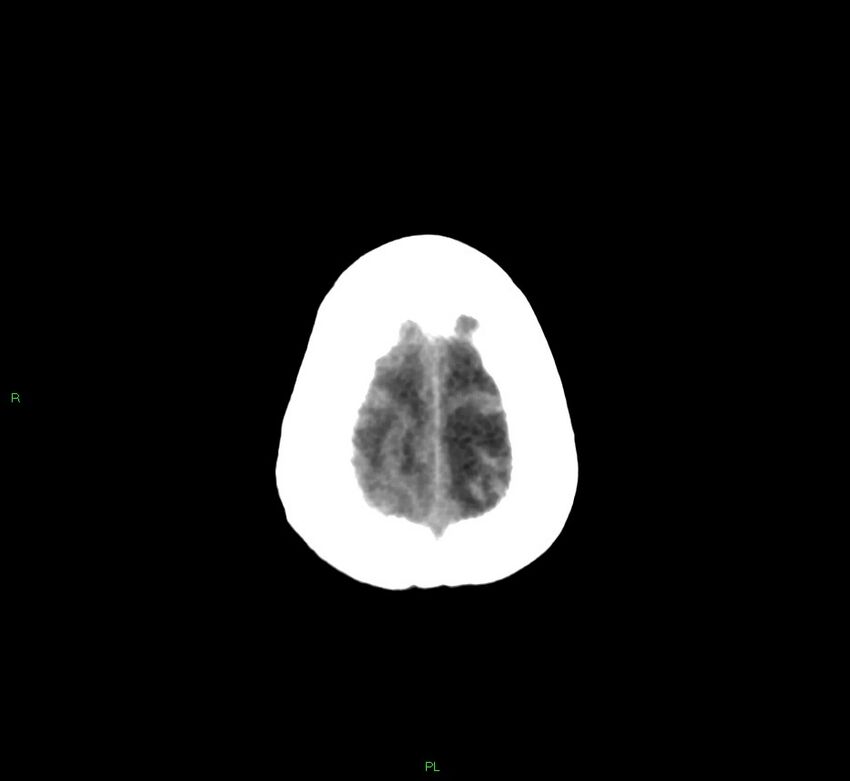 Basal ganglia hemorrhage (Radiopaedia 58766-65988 Axial non-contrast 10).jpg