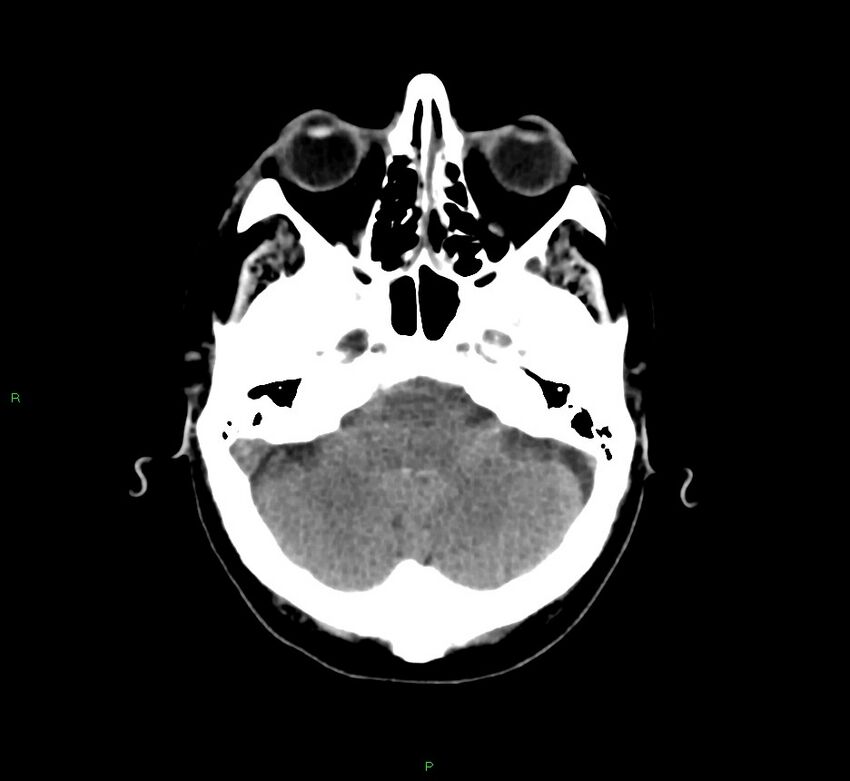 Basal ganglia hemorrhage (Radiopaedia 58775-66008 Axial non-contrast 46).jpg