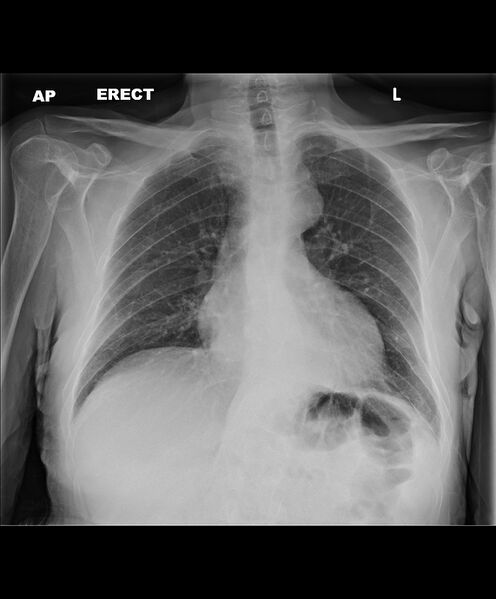 File:Bat wings of pulmonary edema (Radiopaedia 88933-105735 Frontal 1).jpg