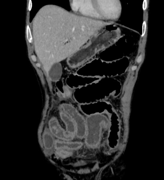 File:Behçet's disease- abdominal vasculitis (Radiopaedia 55955-62570 B 8).jpg