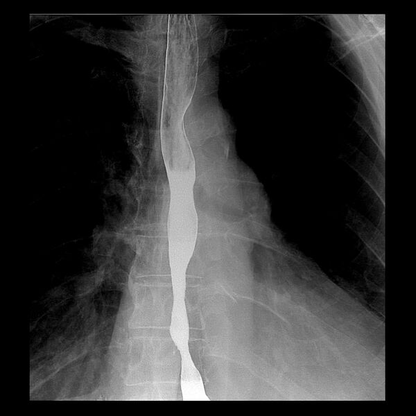 File:Benign esophageal stricture - post reflux (Radiopaedia 75592-86878 C 1).jpg