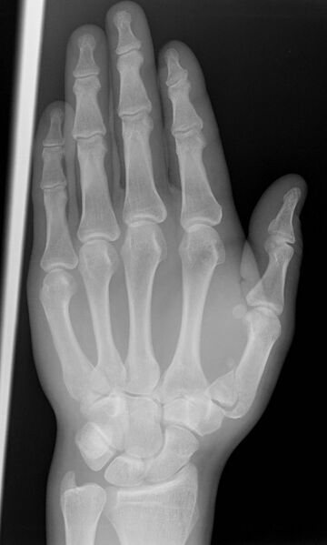 File:Bennett's fracture (Radiopaedia 8803-9605 Frontal 1).jpg