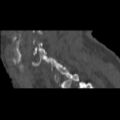 Bilateral C6-7 locked facet dislocation (Radiopaedia 28506-28748 Sagittal bone window 18).jpeg