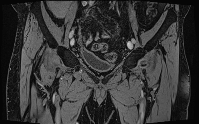File:Bilateral avascular necrosis of femoral head (Radiopaedia 77116-89078 Coronal T2 we 74).jpg