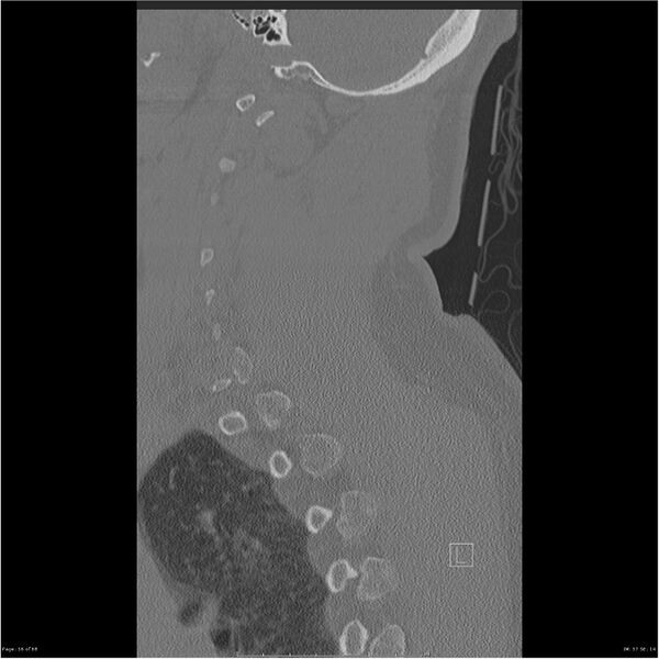 File:Bilateral cervical ribs (Radiopaedia 25868-26017 Sagittal bone window 56).jpg