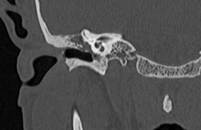 File:Bilateral cholesteatoma (Radiopaedia 54898-61172 Coronal bone window 31).jpg
