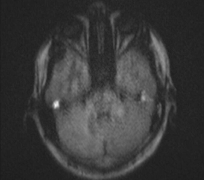 File:Bilateral cholesteatoma (Radiopaedia 54898-61173 Axial DWI 8).jpg