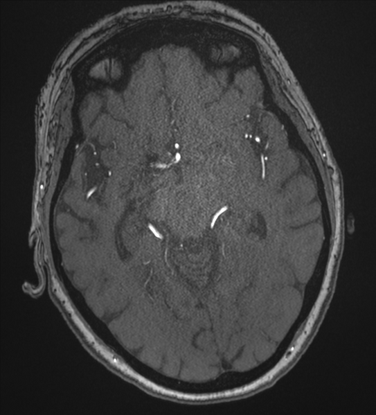File:Bilateral fetal posterior communicating arteries (Radiopaedia 41286-44102 Axial MRA 93).png