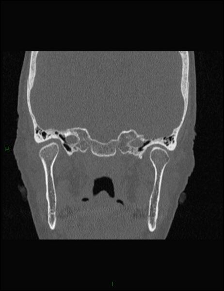 File:Bilateral frontal mucoceles (Radiopaedia 82352-96454 Coronal 281).jpg