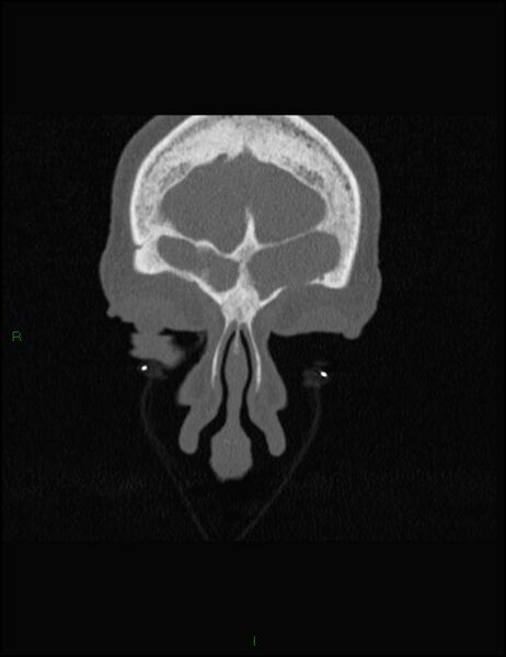 File:Bilateral frontal mucoceles (Radiopaedia 82352-96454 Coronal 57).jpg
