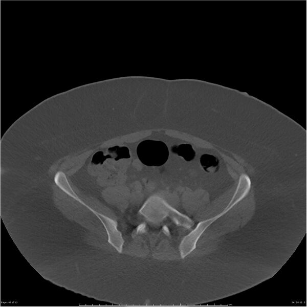 File:Bilateral lumbar ribs (Radiopaedia 25862-26010 bone window 43).jpg