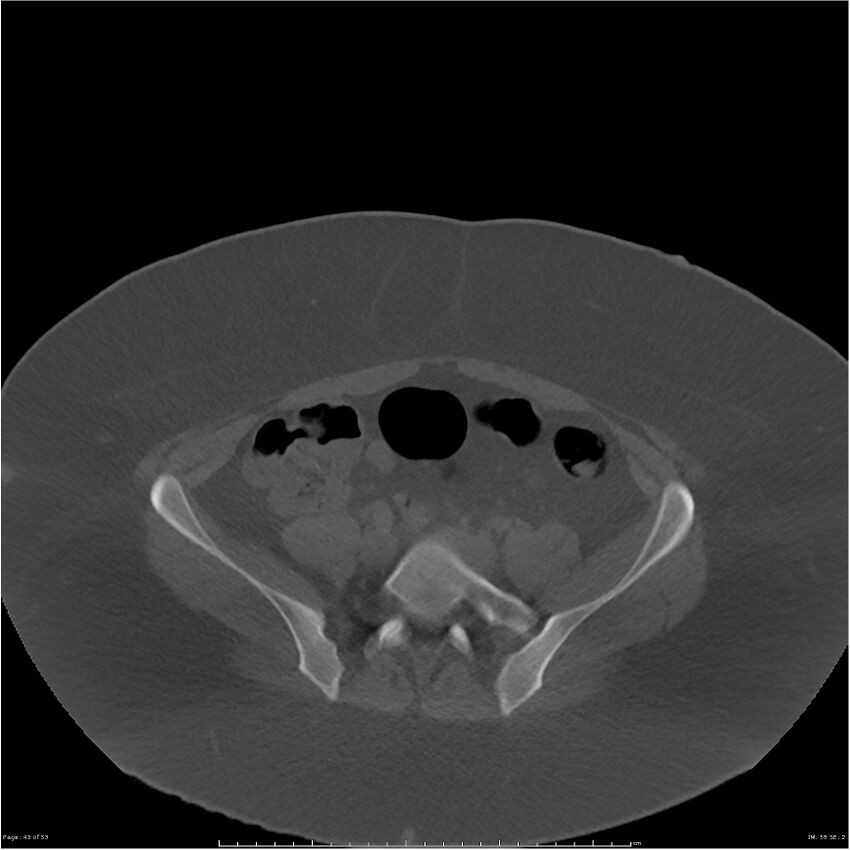 Bilateral lumbar ribs (Radiopaedia 25862-26010 bone window 43).jpg