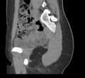 Bilateral mature cystic ovarian teratoma (Radiopaedia 88821-105592 D 14).jpg