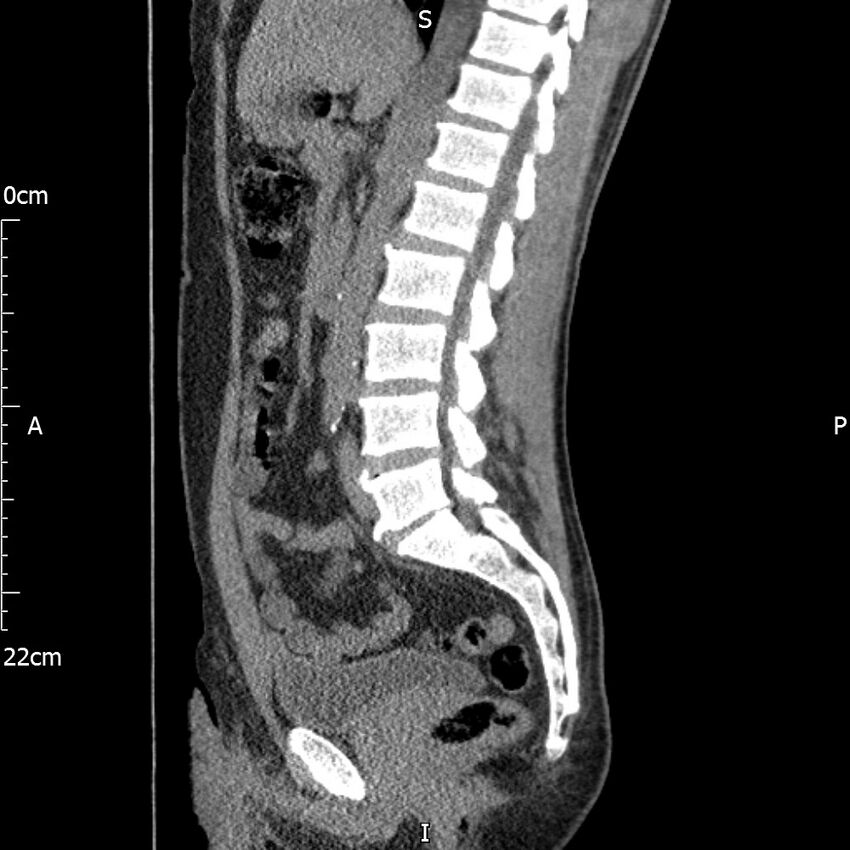 Bilateral medullary nephrocalcinosis with ureteric calculi (Radiopaedia 71269-81569 C 59).jpg