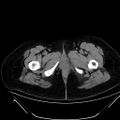 Bilateral ovarian mature cystic teratomas (Radiopaedia 79373-92457 Axial non-contrast 105).jpg