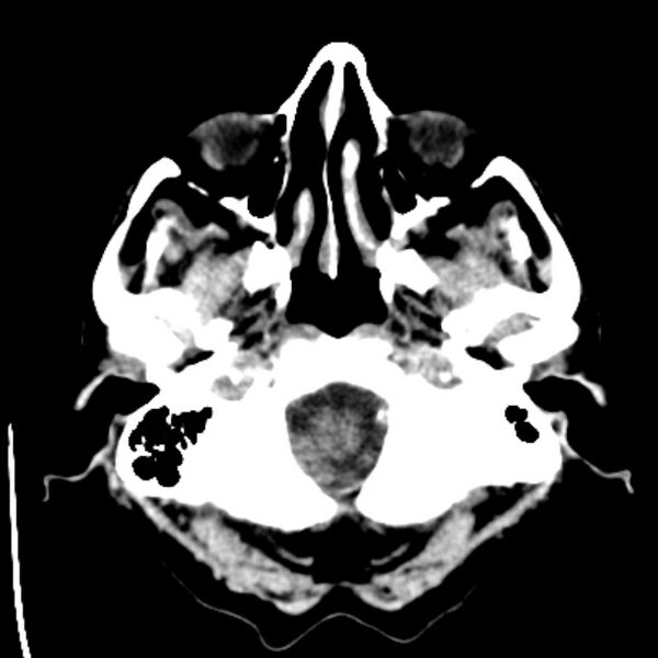 File:Bilateral subdural hygromata (Radiopaedia 29245-29656 Axial non-contrast 4).jpg