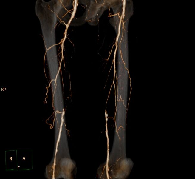 File:Bilateral superficial femoral arterial occlusion (Radiopaedia 25682-25857 3D VR 3).jpg