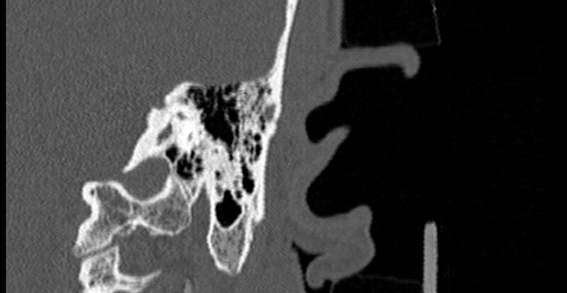 File:Bilateral temporal bone fractures (Radiopaedia 29482-29970 B 65).jpg