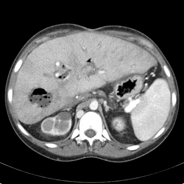 File:Biliary necrosis - liver transplant (Radiopaedia 21876-21846 B 21).jpg