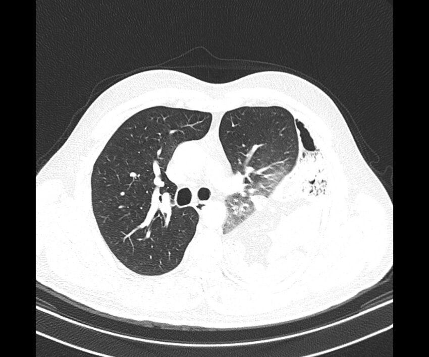 Bochdalek hernia - adult presentation (Radiopaedia 74897-85925 Axial lung window 17).jpg