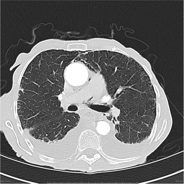 File:Boerhaave syndrome (Radiopaedia 26240-26362 Axial lung window 21).jpg