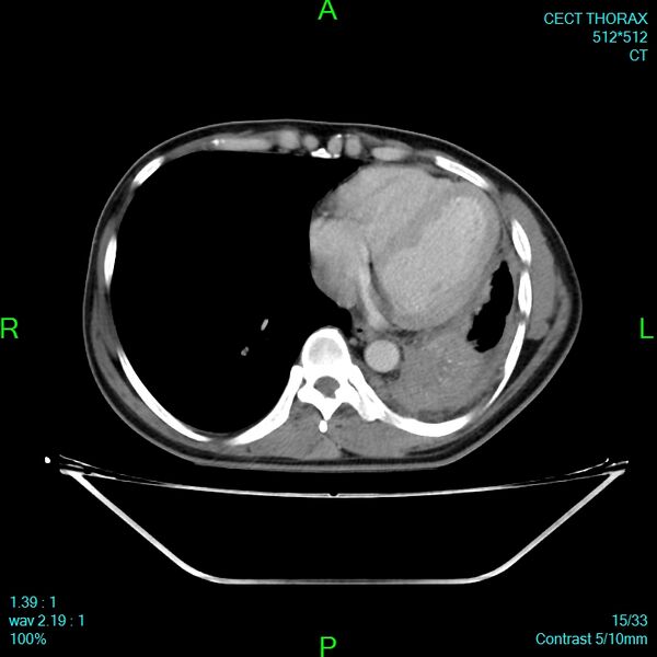 File:Bone metastases from lung carcinoma (Radiopaedia 54703-60937 Axial C+ delayed 15).jpg