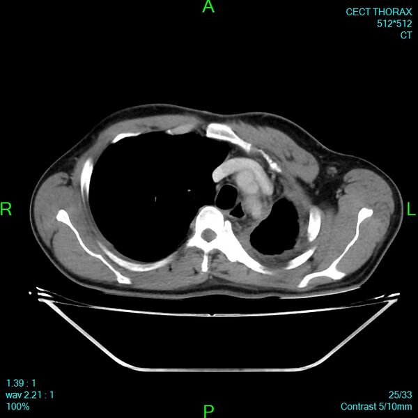 File:Bone metastases from lung carcinoma (Radiopaedia 54703-60937 Axial C+ delayed 25).jpg