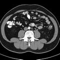 Bosniak cyst - type IV (Radiopaedia 23525-23627 renal cortical phase 47).jpg
