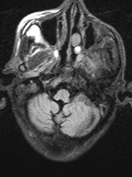 File:Brain abscess with dual rim sign (Radiopaedia 87566-103938 Axial FLAIR 3).jpg