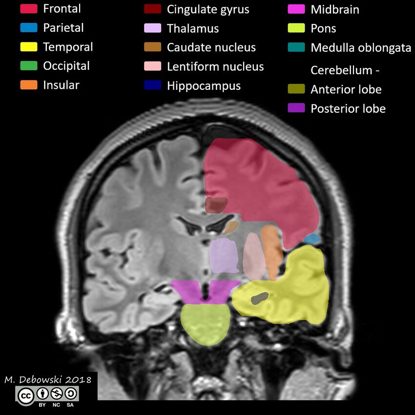 Brain lobes - annotated MRI (Radiopaedia 61691-69700 Coronal 35).JPG